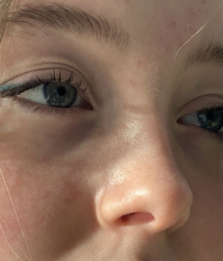 a close up of a person's face with freckles on her nose