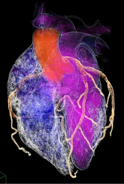 cardiac CT.  Cool pic The Human Heart, Cardiac Nursing, Medical Art, Anatomical Heart, Cardiovascular System, Human Heart, Cardiology, Medical Science, Anatomy And Physiology