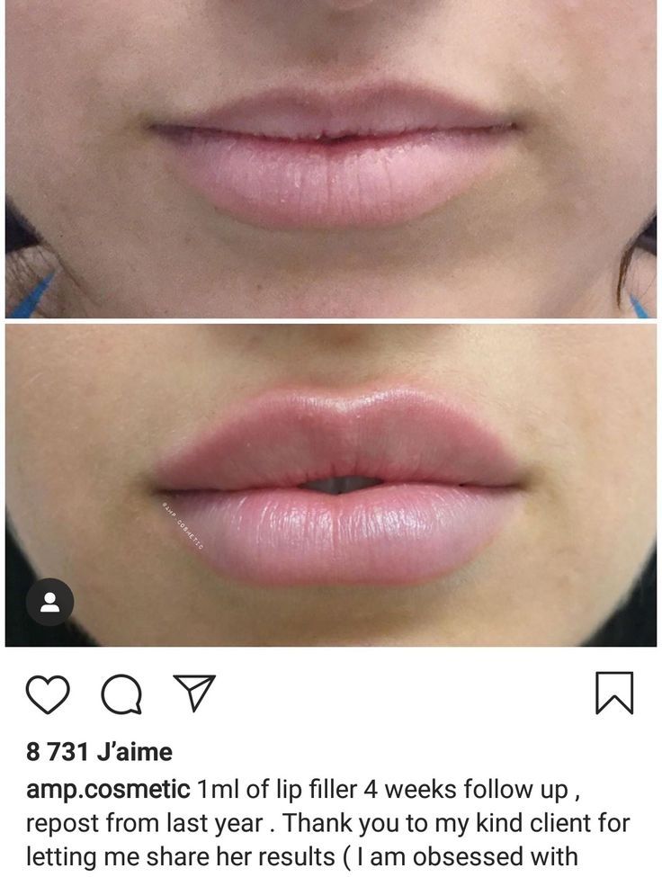 1 ml of lip filler 4 weeks follow up Different Styles Of Lip Filler, Hollywood Lips Filler, Keyhole Pout Lips, Lip Filler Shape Ideas Pouty, Lip Fillers Before And After 1ml Russian, Lip Filler Shape Ideas 1ml, Lip Filler 1 Syringe, Lips Before And After Injections, Lip Injections Shapes