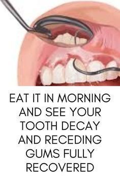 Rebuild Your Teeth and Gums And Get Rid of Tooth Decay.Do This 60 Seconds Dental Trick Before Going to Bed Tonight To Rebuild Your Teeth and Gums.Click the link and watch the full video.#toothdecay #toothproblem #WhatAreOralCare #WhatIsOralCare Reverse Cavities, Tooth Decay Remedies, University Of Adelaide, Tooth Repair, Heal Cavities, Dental Health Care, The Faculty, Teeth Health, Stronger Teeth