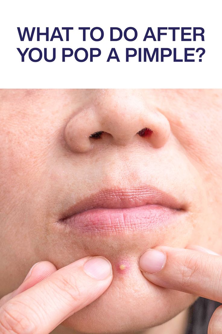 Wondering how to heal a popped pimple? Look no further, because here are some easy tips from board certified dermatologists to get rid of the acne and skin damage. How To Heal A Popped Pimple, How To Heal Popped Pimples Fast, Quickest Way To Get Rid Of Pimples, Pimple Patches Before And After, How To Get Rid Of A Pimple Instantly, Acne Popping, Pimple Solution, Skincare Content, Pimples On Forehead