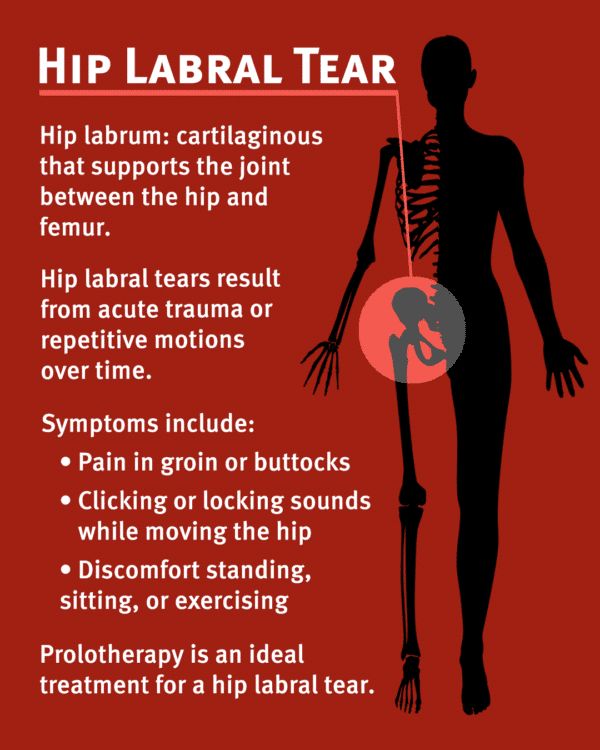 Hip Labral Tear Exercises, Labral Tear Hip Exercises, Labrum Tear Hip, Labral Tear Hip, Hip Labral Tear, Torn Labrum, Muscle Tear, Core Fitness, Hip Strengthening Exercises