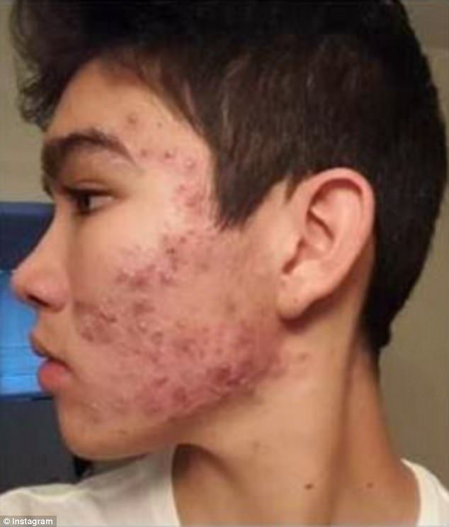 Teenage boy CLEARED severe acne with an $8 moisturizer Budget Skincare, Acne Men, Comedonal Acne, Acne Routine, Teenage Acne, Remedies For Acne, Acne Moisturizer, Bad Acne, Best Acne Products