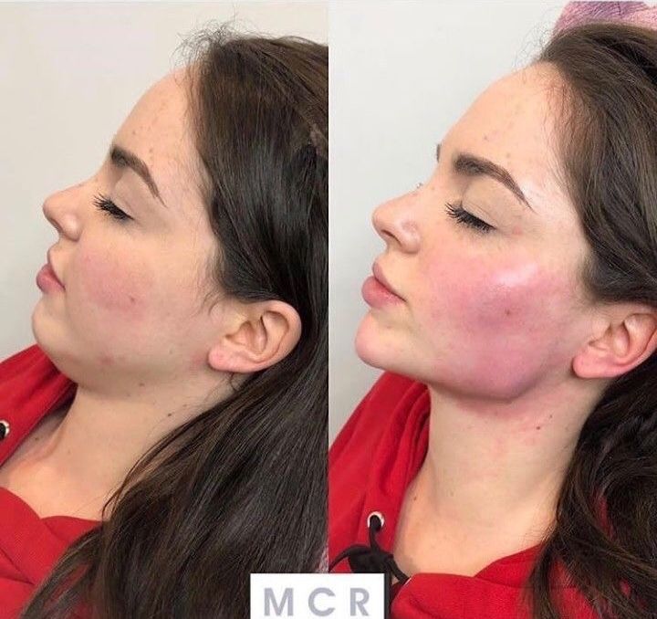 Face Plastic Surgery, Rhinoplasty Nose Jobs, Face Fillers, Face Surgery, Cheek Fillers, Beauty Procedures, Facial Fillers, Facial Contouring, Bold Makeup Looks