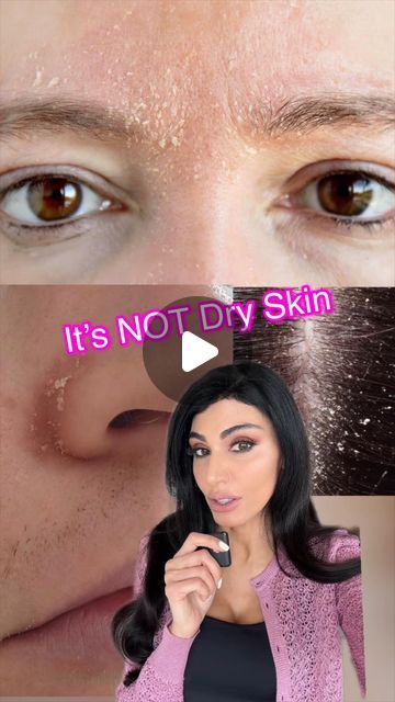 Dr. Azadeh Shirazi on Instagram: "It’s not dry skin! It’s actually from build up of yeast that feed on excess oil and cause a reaction with redness, dry flaky skin around the nose, mouth, and in the eyebrows. Mix SootheHC @azimdskincare with Clotrimazole cream in a 1:1 ratio and apply it to the dry flakes 2-3x a day for 1-2 weeks to clear it.  It’s going to want to come back so prevent flares by washing with medicated shampoos like @headandshoulders with Zinc.  If you still have trouble call me 📞 ⁣ Photo Consults: link in Bio 👆⁣ To see me as a patient⁣ 📲 or text: (858)943-2171⁣ 📩  info@lajollalaserderm.com⁣ ⁣ ⁣ ⁣ ⁣ ⁣ ⁣ ⁣ ⁣ ⁣ ⁣ ⁣ ⁣ ⁣ ⁣ ⁣ ⁣ ⁣ ⁣ ⁣ ⁣ ⁣ ⁣ ⁣ The content of this page is for educational and informational purposes and does not constitute formal medical advice. #seborrheicdermat Flaky Skin On Face, Dry Peeling Skin, Dry Skin Causes, Facial For Dry Skin, Super Dry Skin, Dry Skin Problem, Flaking Skin, Healing Dry Skin, Dry Flaky Skin