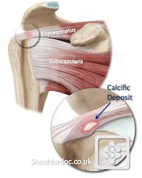 Calcific Tendonitis The pain can be extremely intense. It is one of the worst pains in the shoulder (the other being Frozen Shoulder ). Subscapularis Muscle, Shoulder Muscle Pain, Cystic Ovarian Syndrome, Shoulder Anatomy, Rotator Cuff Exercises, Anatomy Medical, Sports Massage Therapy, Tight Shoulders, Trigger Point Therapy