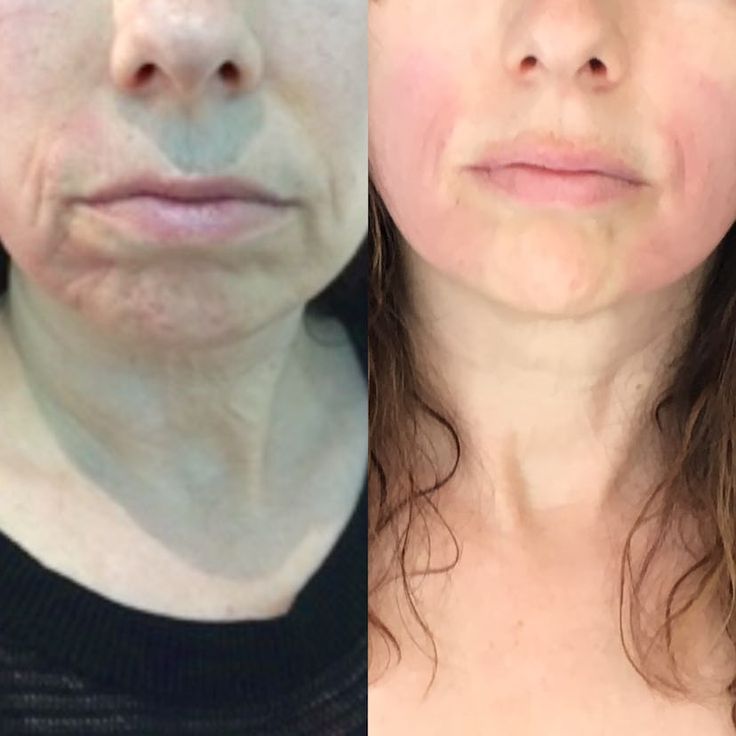 EmFace Review — I Tried The New Skin Treatment That Lifts Without Needles Sagging Skin Face, Facial Procedure, Non Surgical Facelift, Face Tightening, Facial Plastic Surgery, Facial Plastic, Saggy Skin, Facial Exercises, Affordable Skin Care