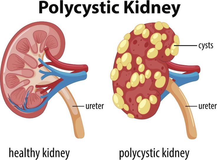 Polycystic Kidneys, Kidney Pain, Healthy Kidneys, Kidney Cleanse, Disease Symptoms, Polycystic Ovaries, Genetic Disorders, Genetic, Disease