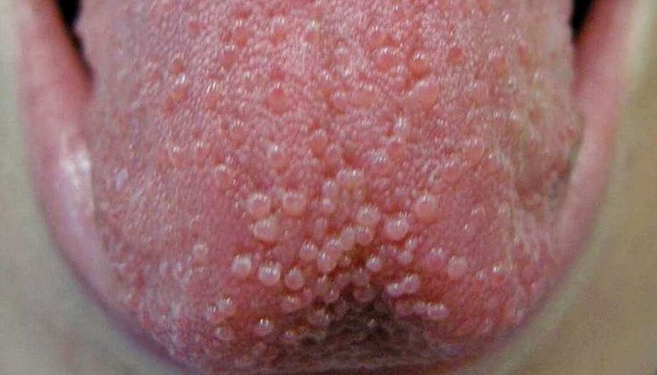 Tongue Bumps: How to Get Rid of Them Lie Bumps On Tongue, Blister On Tongue, Bumps On Tongue, Ulcer On Tongue, Tongue Sores, Homemade Mouthwash, Tongue Health, Nail Care Tips, Nail Health