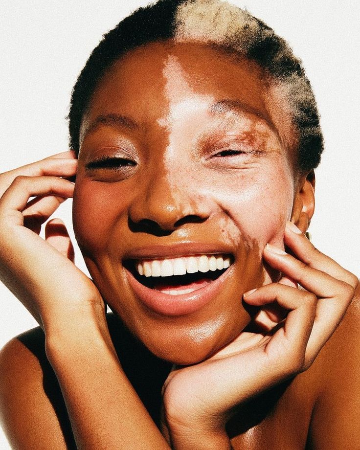 a woman smiling and holding her hands to her face with sunburns on her face