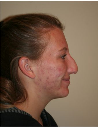 Rhinoplasty Before & After Pictures - RealSelf Nose Job Inspiration Natural, Rhinoplasty Before After, Rhinoplasty Before And After Bulbous, Bad Nose Jobs, Nosejob Rhinoplasty Before After, Bulbous Tip Rhinoplasty, Thick Skin Bulbous Tip Rhinoplasty, Rhinoplasty Before After Dorsal Hump, Facelift Before And After