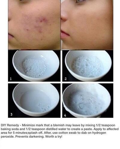 Obličejové Masky, Apply Coconut Oil, Diy Acne, Diy Remedies, Hormonal Acne, Scar Removal, Beauty Remedies, Acne Remedies, Hydrogen Peroxide