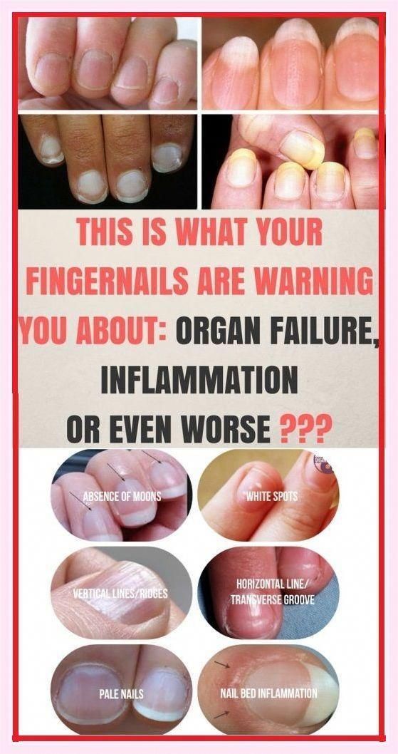 Fingernails Warning by Catherine Chapman | This newsletter was created with Smore, an online tool for creating beautiful newsletters for educators, businesses and more Pale Nails, Nail Conditions, Health Signs, Tongue Health, Striped Nails, Nail Fungus, Nail Health, Healthy Beauty, Yellow Nails