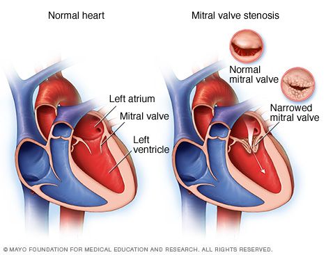 Normal heart and heart with mitral valve stenosis Mitral Valve Regurgitation, Aortic Valve Replacement, Mitral Valve, Heal Thyself, Penyakit Jantung, Heart Valves, Normal Heart, Open Heart Surgery, Congenital Heart