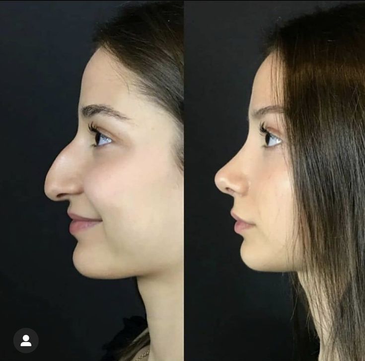 Nose Plastic Surgery, Nose Surgery Rhinoplasty, Plastic Surgery Fail, Rhinoplasty Nose Jobs, Face Surgery, Rhinoplasty Before And After, Plastic Surgery Gone Wrong, Big Nose Beauty, Pretty Nose