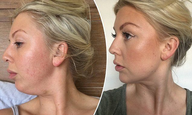 How one woman finally got rid of her double chin WITHOUT liposuction Fat Burning Water, Chin Reduction, Lipo Before And After, Moisture Face, Undereye Bags, Double Menton, Aging Backwards, Neckline Slimmer, Face Exercises