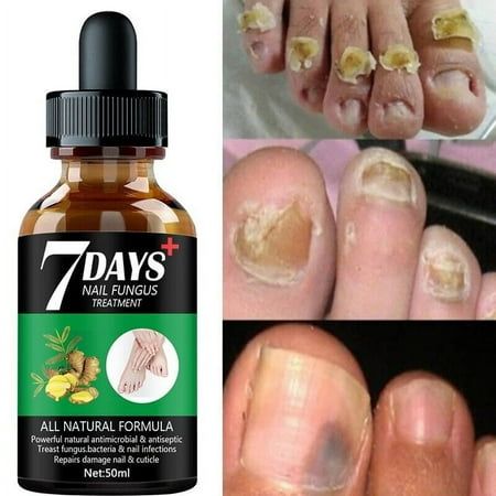 7 Days Nail Fungus Treatment Hand Foot Care Removal Repair Gel Anti-infective Color: Green. Fungal Infection Remedies, Toenail Fungal Infection, Nail Discoloration, Essence Serum, Nail Fungus Remedy, Hand And Foot Care, Nail Infection, Fungal Nail, Nail Repair