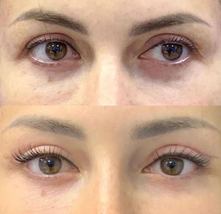 Almond Eye Surgery, Cat Eye Surgery, Upper Blephoraplasty Before And After, Blephoraplasty Surgery, Blephoraplasty Before And After, Eye Lift Surgery, Jaw Reduction Surgery, Surgery Aesthetic, Body Plastic Surgery