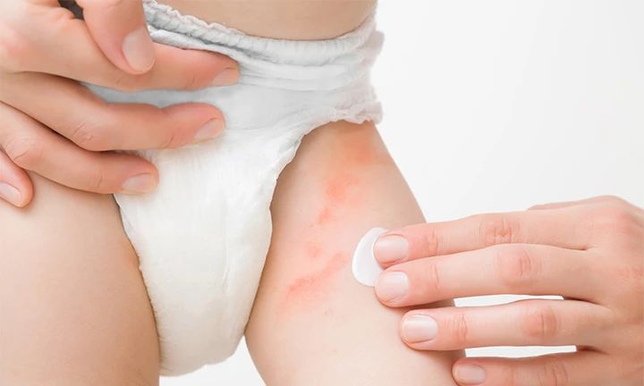 a woman is peeling off her knee with an adhesive bandage on it's arm