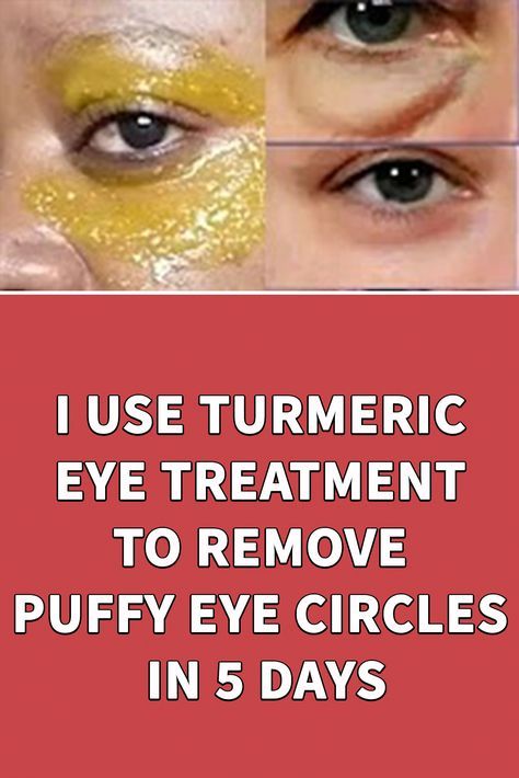 Puffy Eyes Remedy, Puffy Eye, Wrinkle Free Skin, Remove Dark Circles, Skin Care Wrinkles, Dark Circles Under Eyes, Personal Questions, Eye Circles, Eye Wrinkle