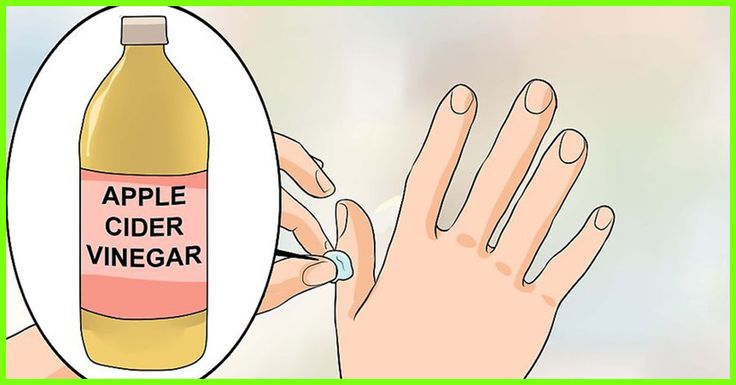 Filiform Wart, Warts Removal, Wart On Finger, Types Of Warts, Warts On Hands, How To Remove Warts, Home Remedies For Warts, Warts Remedy, Remove Warts