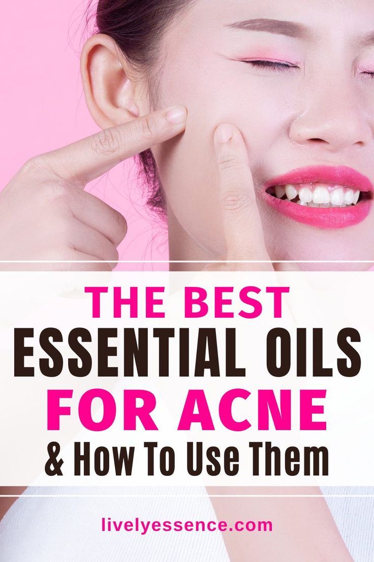 Here are the best essential oils for acne. They are the most effective for treating scars, pimples and breakouts, reducing acne redness. They help reduce inflammation and are antimicrobial. Learn how to use essential oils for acne and get clear skin. #essentialoils #acne Deep Pimple, Essential Oils For Acne, Oils For Acne, Juniper Berry Essential Oil, Acne Redness, Get Clear Skin, Oregano Essential Oil, List Of Essential Oils, Frankincense Oil