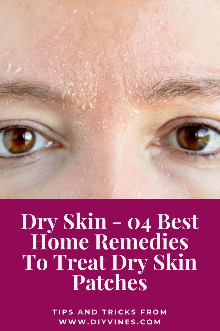 How To Get Rid Of Dry Skin Around Nose, How To Treat Dry Skin On Face, Dry Skin Around Nose, Remedy For Dry Skin On Face, How To Remove Dry Skin From Face, Natural Remedies For Dry Skin, Dry Red Skin On Face, Home Remedy For Dry Skin On Face, Dry Peeling Skin On Face