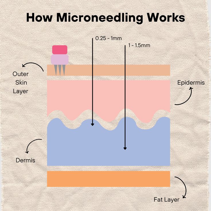 The only simple guide you need to microneedling ✨  Watch the wonders of microneedling unfold when you perform your treatments under optimum conditions! #microneedling #dermaroller #skincare #collagenboosting #glowingskin #skinrenewal #microneedlingbenefits #healthyskin #skincareroutine #dermapen #skinrejuventation #youthfulskin #beautytreatment #flawlesscomplexion #microneedlingtherapy #beautysecrets #dermapenfacial #collageninductiontherapy #microneedling101 #skincaresoloutions #glowgetter Microneedling After Care Instructions, Derma Roller Results, Microneedling Promotion, Skinpen Microneedling, After Microneedling, Microneedling With Prp, Acne Scaring, Derma Pen, Fractional Laser