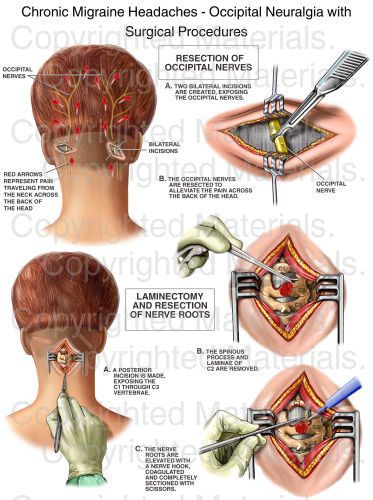 Chronic Migraine Headaches - Occipital Neuralgia with Surgical Procedures : Medical Chart Migraine Help, Occipital Neuralgia, Headache Relief Instant, Throbbing Headache, Chiari Malformation, Migraine Pain, Migraine Prevention, Surgical Procedures, Natural Headache Remedies