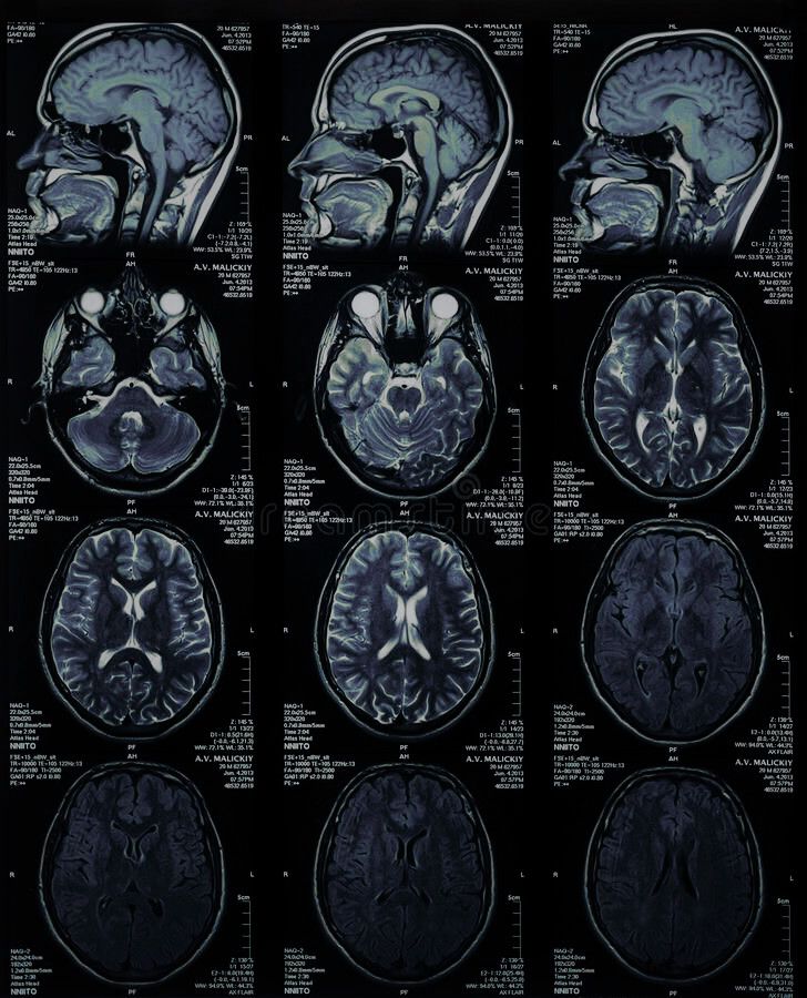 an mri scan shows the different areas of the human brain, including the frontal area