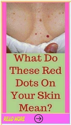 What do these red dots on your skin mean. Red Spots On Skin, Meaning Of Red, Spots On Skin, Health Signs, Skin Tags, Women Health Care, Patient Education, Health Tips For Women, Women Health