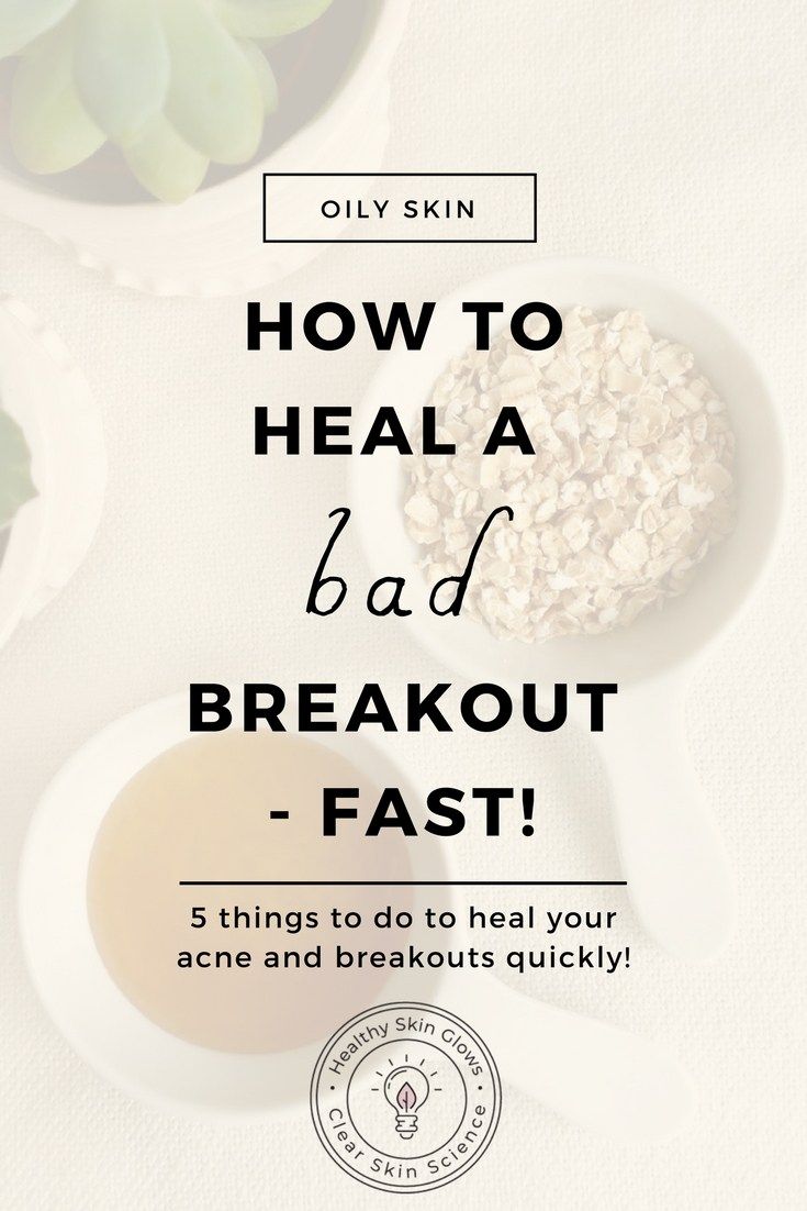 Want to get rid of breakouts quickly? Do these 5 things every time you are having a breakout to heal it super quick! Breakout Remedies, Forehead Acne, Bad Acne, Get Rid Of Acne, Rid Of Acne, Natural Acne Remedies, Natural Acne, Acne Spots, Cystic Acne