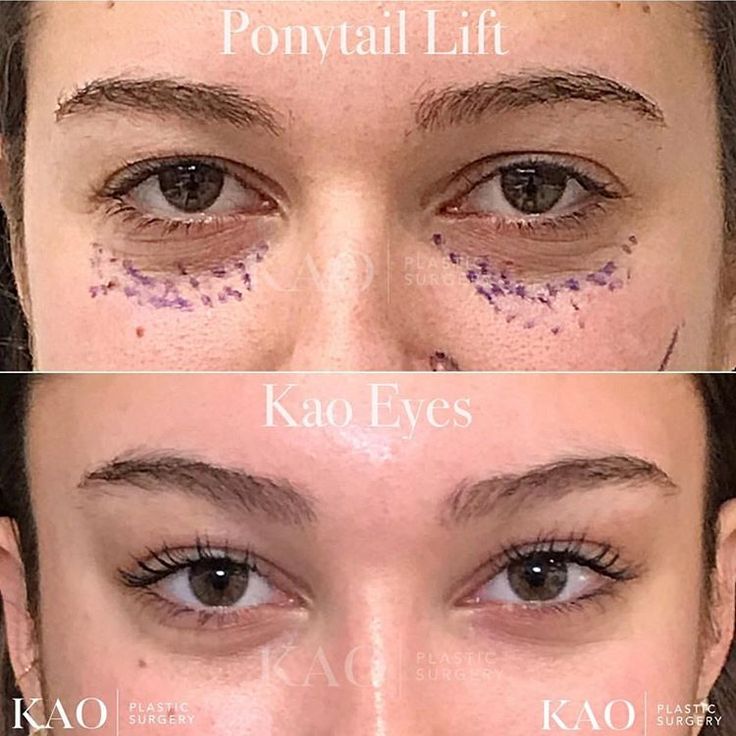 cat eye surgery | pony tail lift | plastic surgery | cirugía cosmética | blepharoplasty | Eye Lift Surgery, Kylie Jenner Eyes, Face Plastic Surgery, Easy Cat Eye, Cat Eye Tutorial, Face Fillers, Plastic Surgery Gone Wrong, Eye Tricks, Facial Fillers