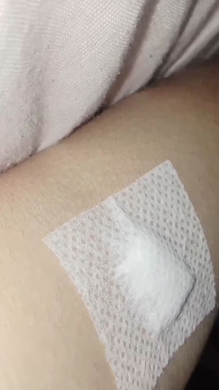 a person's arm with bandages on it and a patch in the middle of his arm