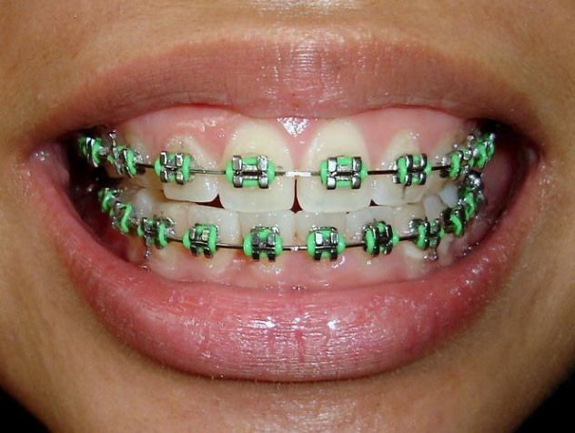 Dental Braces Colors, Braces Colors Combinations, Invisible Teeth Braces, Green Braces, Braces Retainer, Braces Bands, Cute Braces Colors, Kids Braces, Braces Tips