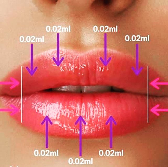 Botox Injection Sites, Dermal Fillers Lips, Derma Fillers, Lips Inspiration, Face Fillers, Botox Lips, Aesthetic Dermatology, Facial Anatomy, Botox Face