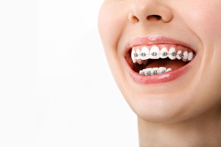 How Do I Care For My Teeth While Wearing Braces? #braces #orthodontictreatment #allsmilesdentalspa Orthodontics Teeth, Dental Animation, Dentist Art, Straight Smile, Dental Social Media, Dental Images, Dental Spa, Traditional Braces, Orthodontic Appliances