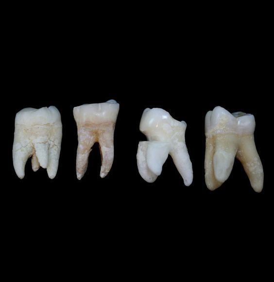 three dental crowns are shown on a black background