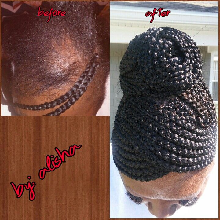 Braided Updo for Alopecia clients lisha_da_braider IG Box Braids Updo, Alopecia Hairstyles, Scalp Braids, African Hair Braiding Styles, Box Braids Hairstyles For Black Women, Braided Ponytail Hairstyles, Braid Hair, Braided Hairstyles Updo, Cornrows Braids