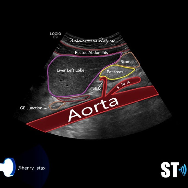 an x - ray shows the location of aorta