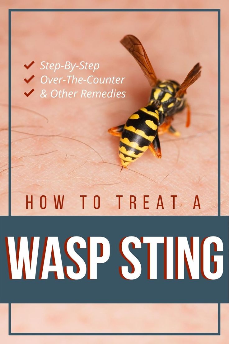 how to treat a wasp sting