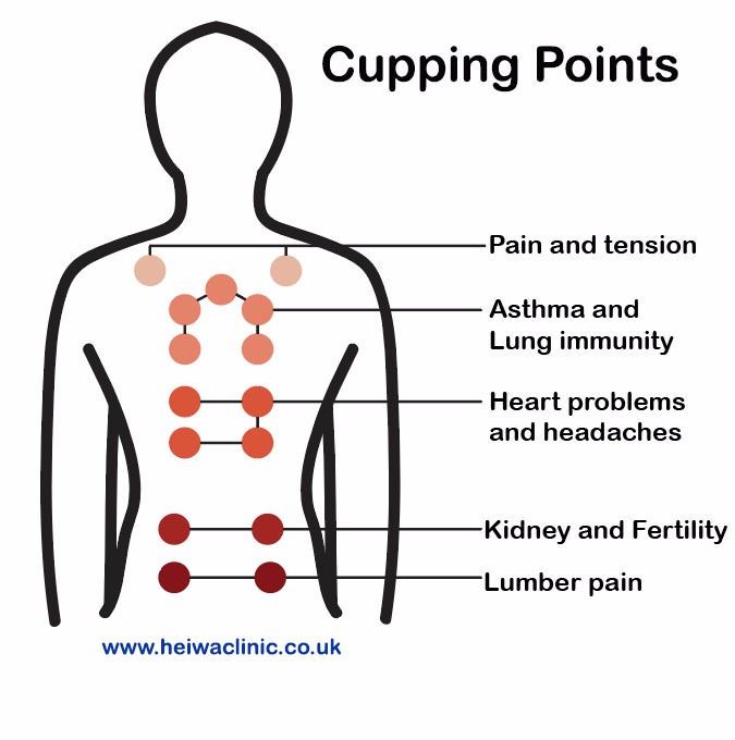 Cupping Therapy for better health Hijama Points, Cupping Points, Affinity Photo Tutorial, Somatic Movement, Hijama Cupping, Full Body Massage Techniques, Massage Therapy Business, Body Massage Techniques, Cupping Massage