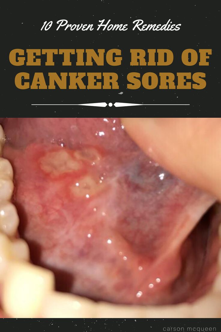 Find out how to get rid of canker sores using home remedies found in your kitchen! Say goodbye to these persistent wounds for good!  #cankersore #cankersoreremedy #howtogetridofcankersore #cankersoreremedytongue ##cankersoreremedymouth #howtogetridofcankersorefast What Causes A Canker Sore, Cold Sore Inside Mouth Remedy, How To Get Rid Of A Canker Sore Fast, How To Get Rid Of Cold Sores Overnight, Canker Sore Remedy Overnight, Canker Sore On Tongue, Canker Sore Causes, Gum Pain Relief Remedies, Gum Sores