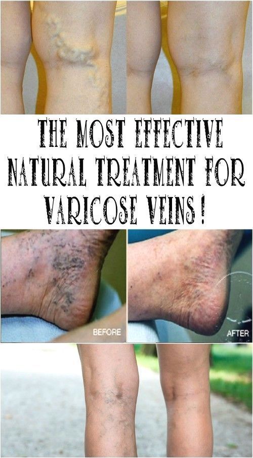 How To Get Rid Of Varicose Veins Naturall Varicose Vein Remedy, Vein Removal, Home Medicine, Health Tips For Women, Health Advice, Health Info, Natural Treatments, Natural Medicine, Health Remedies