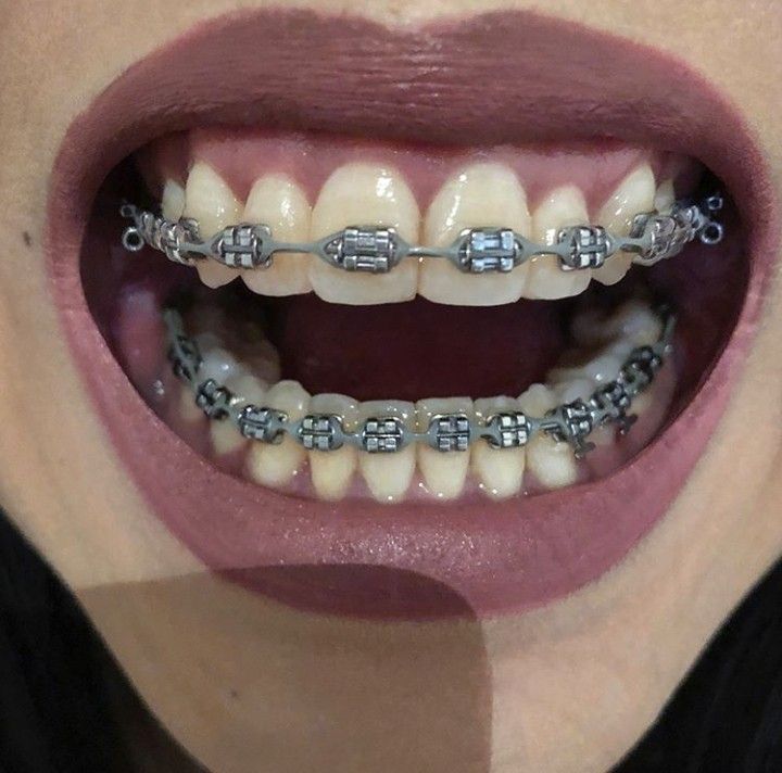 Power Chain Braces, Braces Retainer, Cute Braces Colors, Adult Braces, Braces Tips, Getting Braces, Braces Girls, Cute Braces, Brace Face