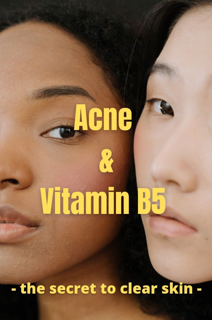 Vitamin For Acne Clear Skin, Best Vitamins For Acne, Vitamins For Hormonal Acne, Vitamins For Acne Clear Skin, Face Acne Remedies, Supplements For Acne, Acne Chart, Best Acne Scar Removal, Cystic Acne Remedies