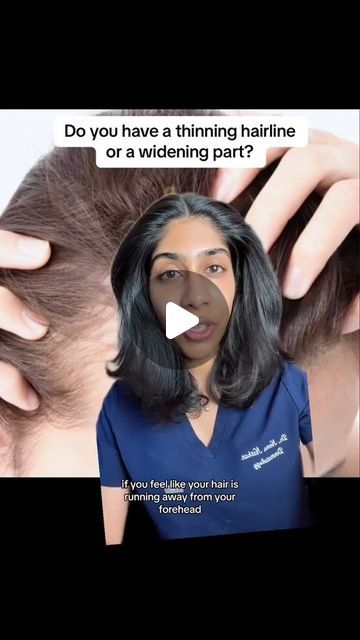 #greenscreen Androgenetic alopecia is a common type of hair loss caused in part by an imbalance of a hormone called DHT. It can present a... | Instagram Balding Women Help, How To Reverse Hair Thinning, Women Receding Hairline Hairstyles, Hair Lossing Tips Natural, Nutrafol Before And After, Androgenic Alopecia In Women, Hairstyles For Balding Woman, Receding Hairline Women, Female Balding