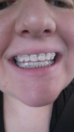 Ceramic Braces on top Braces On Top Teeth Only, Braces Types, Braces Advice, Braces Top Teeth Only, Clear Braces Ceramics, Clear Braces With Color Bands, Braces Color Wheel, Braces On Gapped Teeth, Braces Before And After