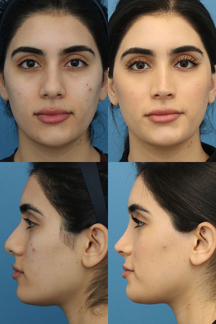 Lip Plastic Surgery, Bad Nose Jobs, Nose Surgery Rhinoplasty, Celebrity Surgery, Bulbous Nose, Plastic Surgery Fail, Rhinoplasty Nose Jobs, Face Surgery, Rhinoplasty Before And After