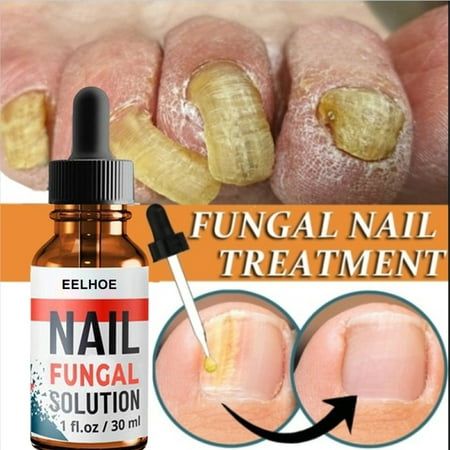 Stay away from the gray nails, make your nails more healthy and beautiful! Here is a detailed guide to nail care for all your intermediate nail care needs! Description:Nail fluid barbs from cracking to gray nails Product name: Nail fluid Specification: 30 ml Properties: Liquid It moisturizes the skin, spiny growth around the nails, softens the skin and keeps nails healthy and shiny. Massage to complete absorption, can make the finger edge skin without barbs and skin. fluid are very good for your Toenail Fungal Infection, Nail Polish Painting, Nail Infection, Fungal Nail, Nail Repair, Damaged Nails, Ingrown Toe Nail, Gray Nails, Toenail Fungus